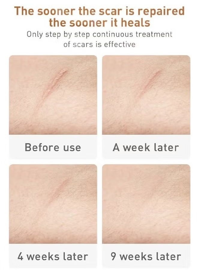LANBENA Skin Care Gel, Herbal repair scar cream 30g, scar gel, skin repair gel, natural plant ingredients, effectively repair old and new scars, burns, stretch marks, acne, sunburn, 30g - Image 4