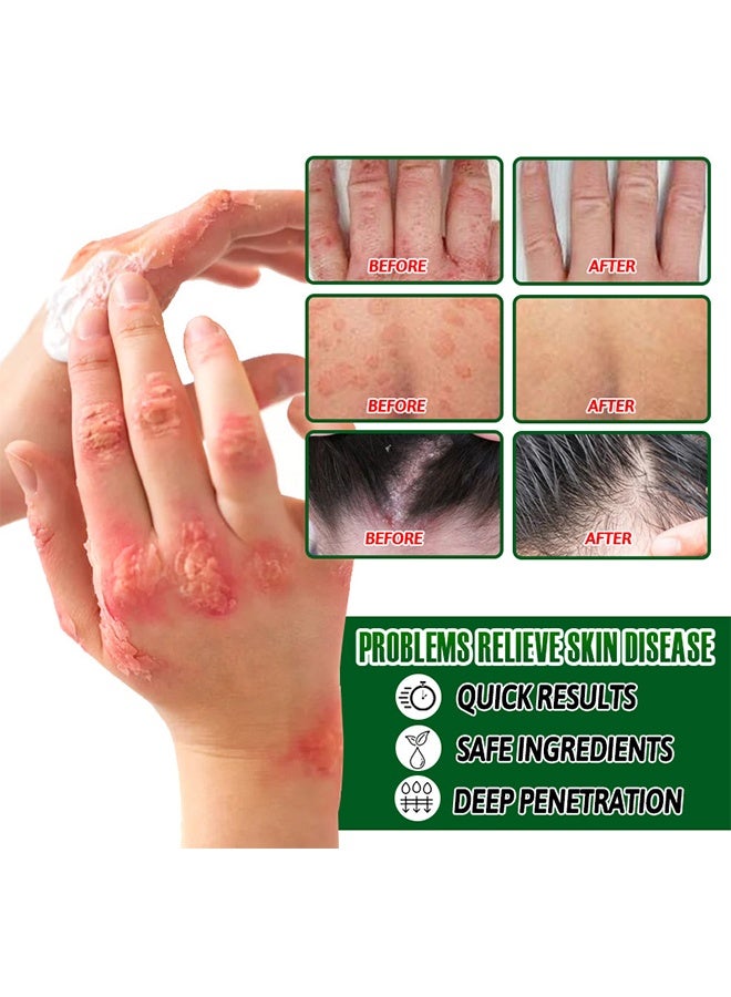 ERAYCEE Psoriasis Cream, Anti-Itching Dermatitis Herbal ointment, Powerfully Inhibits Fungi ,quickly relieves psoriasis, suitable for itching all over the body 20G - Image 2