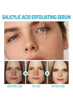 BIOAQUA Acne Removal Essence, Brightening Treatment Serum,Face Serum for Sensitive Skin and Acne 30ml  - Image 2