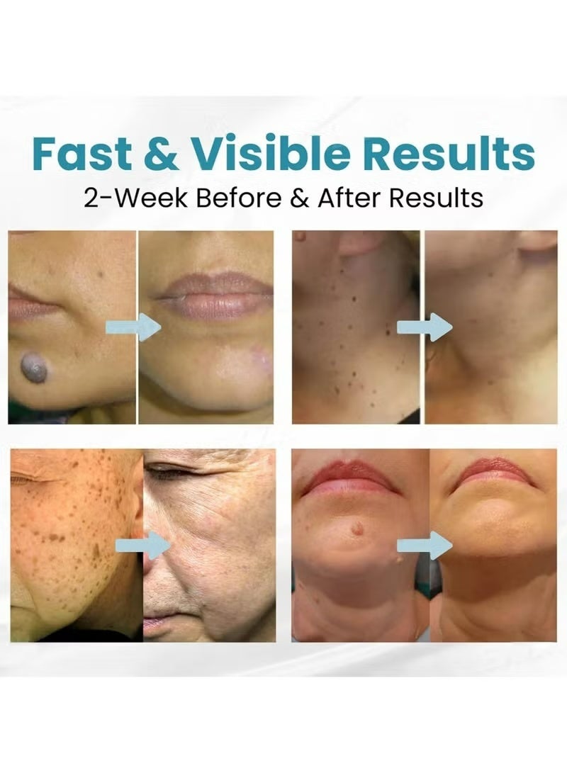 Mole and Wart Removal Pen, Non-Invasive Mole and Wart Removal, 2025 Upgrade New Skin Tag Removal Pen, Smoothes and Reduces Blemishes,Suitable for All Types - Image 3