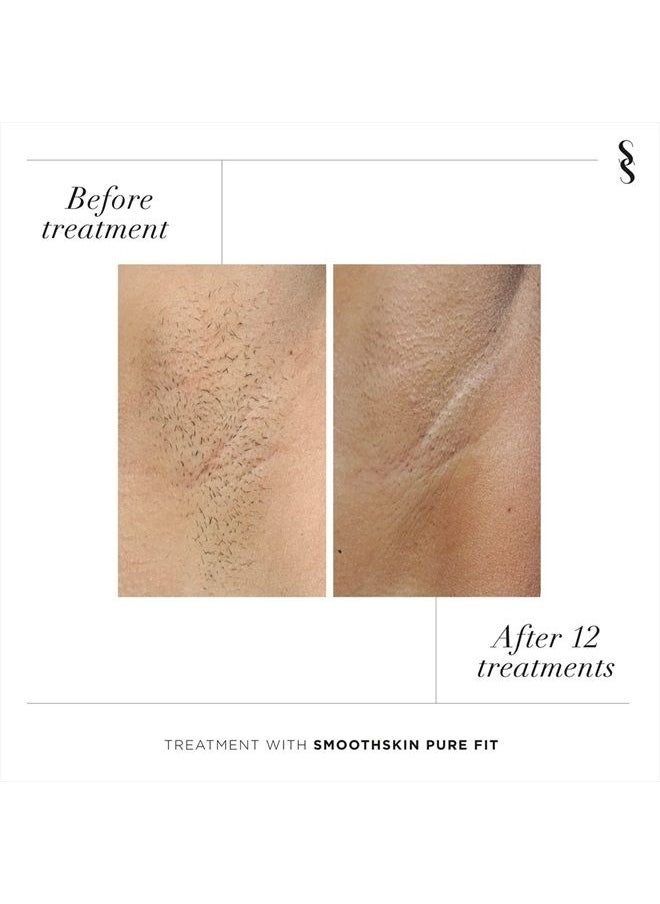 SMOOTHSKIN - SmoothSkin Pure FIT Intelligent Ultrafast IPL Permanent Hair Reduction for Women & Men - Body & Face – FDA Cleared - Image 1