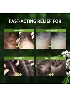 Roycederm RoyceDerm Tea Tree Scalp Relief Spray: Leave-In Scalp Care for Dry, Flaky, and Itchy Scalp - Tea Tree Oil Formula for Comfort, Hydration, and Balance - Conditioning Support for Women & Men  - Image 3