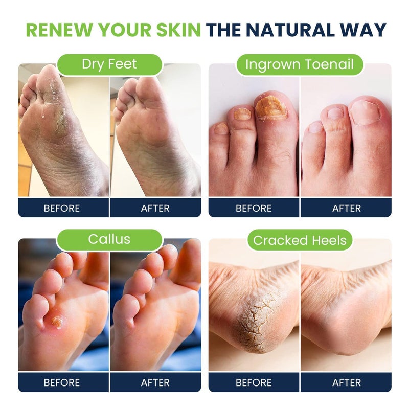 FOOT CURE Tea Tree Oil Foot Soak with Epsom Salt - Best Toenail Fungus Treatment, Athletes Foot & Softens Calluses - Soothes Sore & Tired Feet, Fungal Toe, Foot Odor Scent, Spa Pedicure (Pack of 2) - Image 3