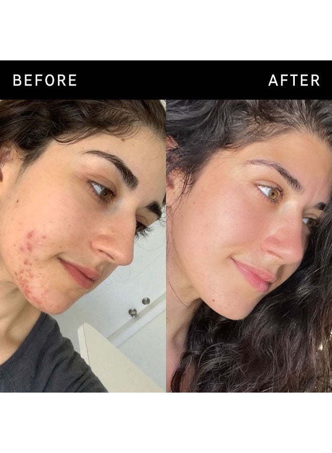 علاج عيوب البشرة بحمض السكسينيك من ذا إنكي ليست - Image 4