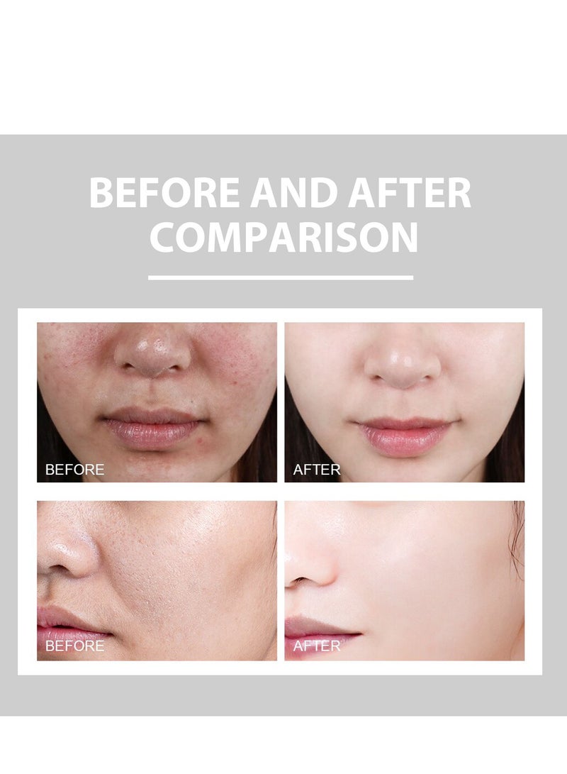 EELHOE Anti-Acne Cream, Face Moisturizer Cream for Acne Prone Skin, Acne Control Facial Cream with Hyaluronic Acid and Niacinamide, Acne Remover Cream for Hydrating, Skin Care for Sensitive Skin 50G - Image 3