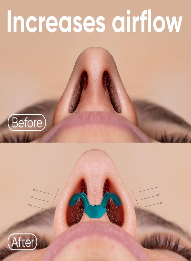Brison Nasal Dilators - Nose Vents Opener for Better Breathing and Adults for Sleep and Activity Improves Airflow - 2pcs Soft-Hard - Image 3