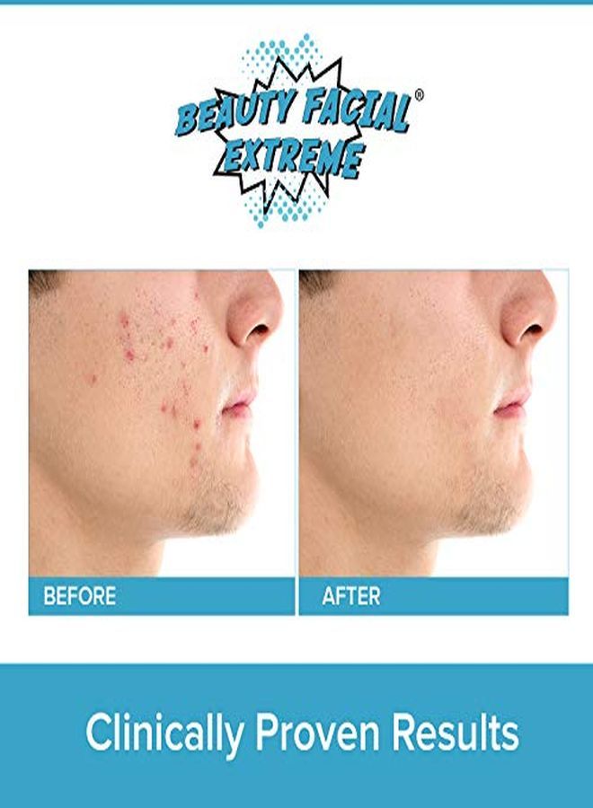 Beauty Facial Extreme Acne Treatment Pads Contains Salicylic, Glycolic, & Lactic Acid For Face & Body. Eliminates Oily Skin, Clogged Pores & Cystic Breakouts. Remover For Dark Spots, Whitehead & Blackhead Pimples.  - Image 4