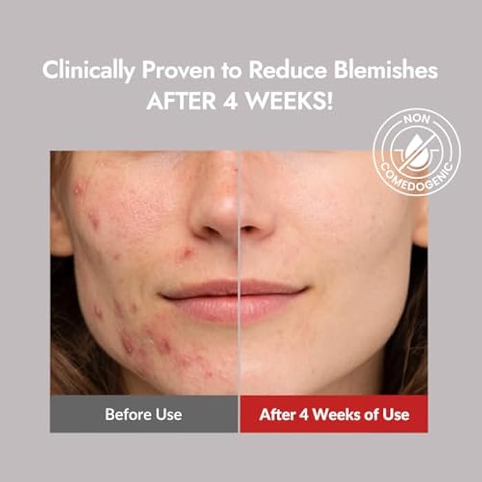 MIZON Good Bye Blemish Low pH Cleanser, Cleanser for troubled skin, Acne Treatment, Breakout Treatment, Korean Skincare, Acne Spot Treatment, Soothing for sensitive skin(100ml 3.38 fl oz) - Image 5