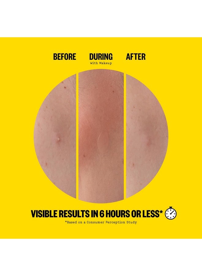 PEACE OUT - PEACE OUT Skincare Acne Day Dot. 6-hour Fast Acting Sheer Hydrocolloid Pimple Patches with Salicylic Acid, Ultra-Thin, Virtually Invisible, Quickly Clear Breakouts, Blemishes and Zits, 20 dots - Image 1