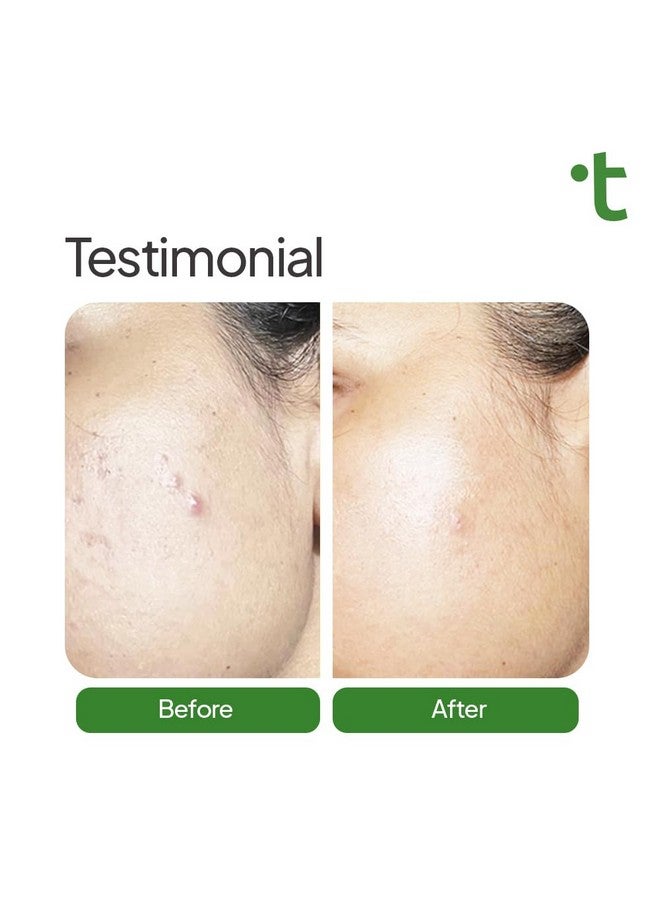 Twasa 10% Niacinamide Face Serum with Zinc | Fights Acne & Oil Control | Serum for Acne And Dark Spots | Pore Minimizing & Skin Brightening Serum for Oily, Acne-Prone | 30ml - Image 3
