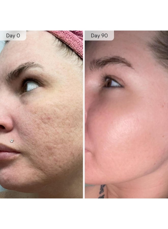 Qure Skincare Micro-Infusion System | At-Home Microneedling Facial | 24K Gold 0.5mm Needles | Hydrating & Anti-Aging Serums | Pore-Minimizing, Collagen-Boosting & Skin Rejuvenating | 3-Month Supply - Image 3