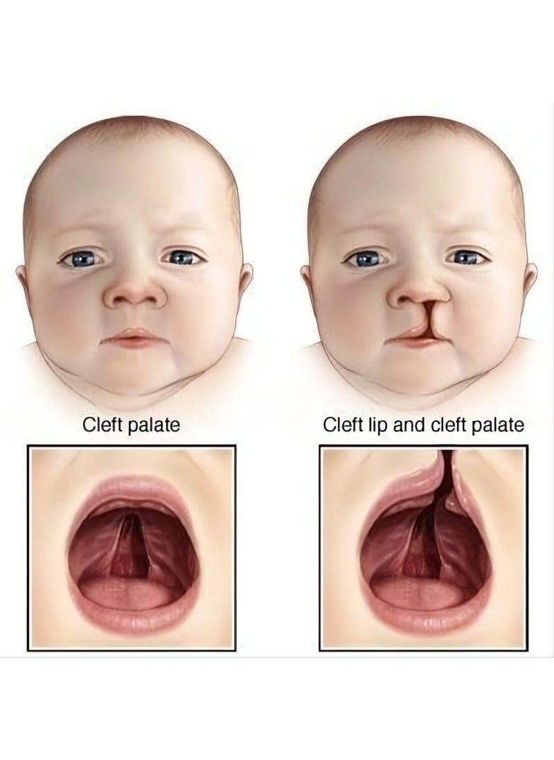 Japlo - Feeding bottle for special cases, cleft lip and premature birth, 140 ml - Image 1