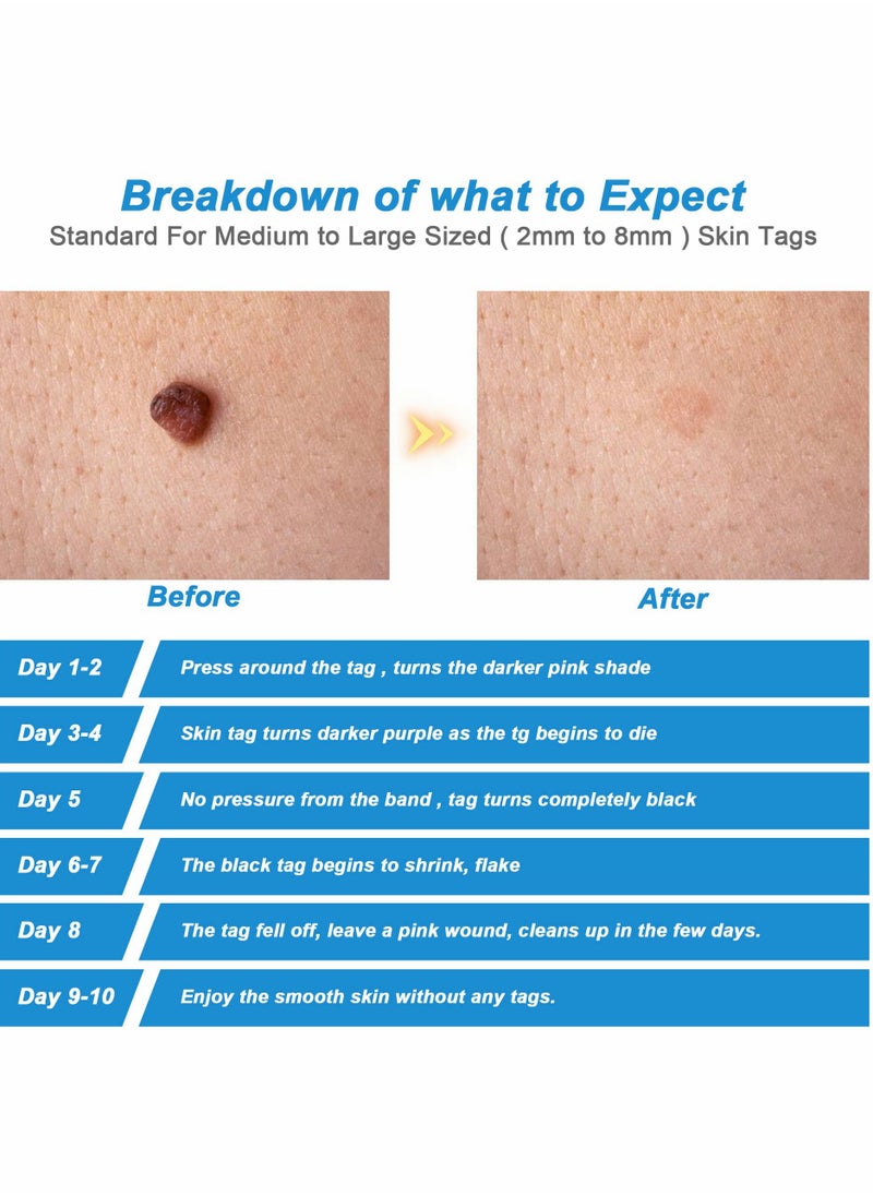 Skin Tag Remover,Painless Remover Pen,Skin Removal Kit Tools with 40 Micro and Regular Bands,Easy Device to Remove (2mm-8mm)