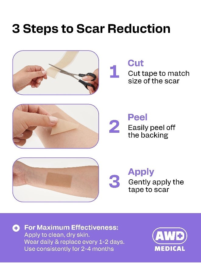 AWD Medical AWD Silicone Scar Sheets for Surgical Scars Medical Grade Silicone Scar Tape for C Section Tummy Tuck Tape Keloid Treatment Silicone Skin Patches After Surgery Must Haves 16 x 120 Roll - Image 3