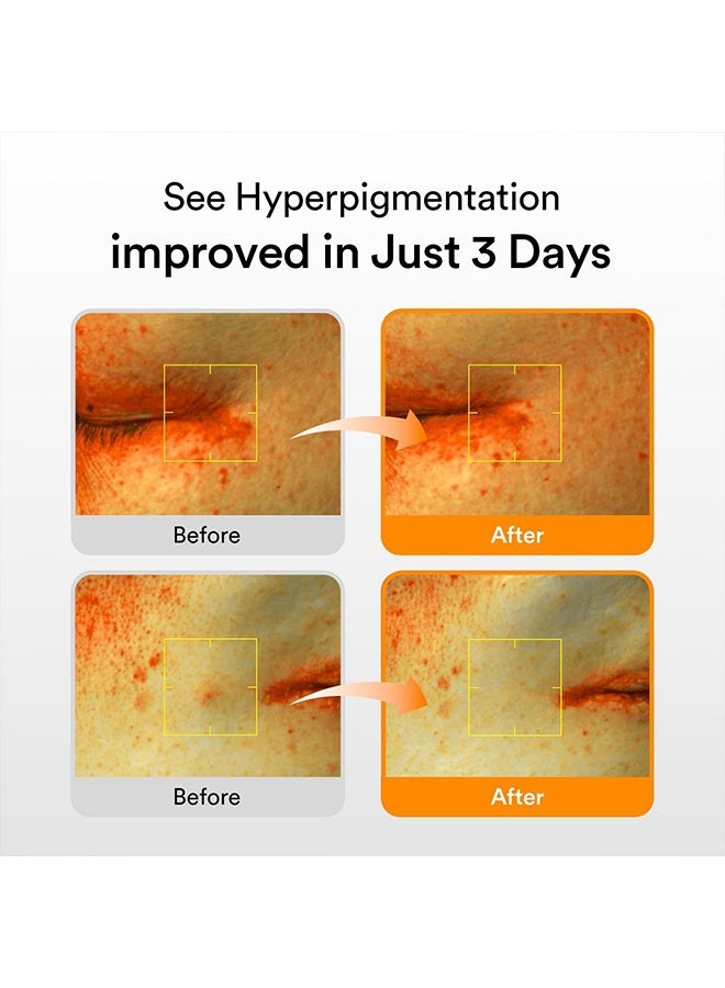 ابيب سيروم جلوتاثيوزوم للبقع الداكنة فيتا دروب | علاج البقع الداكنة وفرط التصبغ | سيروم لتفتيح البشرة الحساسة وغير المتساوية | نياسيناميد، فيتامين سي - Image 4