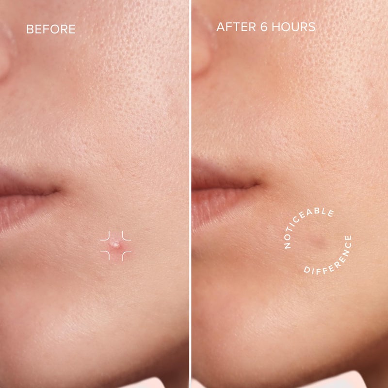 MAREE Star Pimple Patches for Face - Hydrocolloid Acne Patches w/Salicylic Acid, Tea Tree Oil & Centella - Cute Pimple Patches Stars - Teens Zit Patches Stickers - Parches Para Acne - 72 Blemish Dots - Image 3