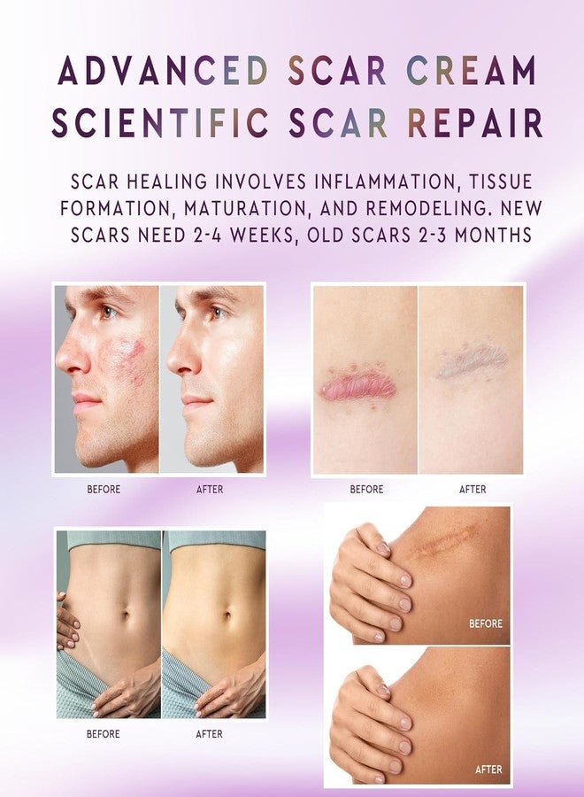 suquato Advanced Silicone Scar Removal Cream – Professional Keloid Scar Treatment, Surgical Scars, C-Section, Hysterectomy, Mastectomy, Tummy Tuck, Acne Marks & Keloid Bump Removal Treatment – 30g - Image 3