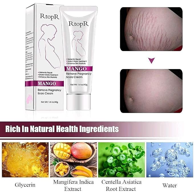 MQUPIN RtopR Mango Stretch Marks and Scar Cream -Stretch Marks and Scar Removal Cream for Pregnancy - Best Body Moisturizer-80g - Image 2