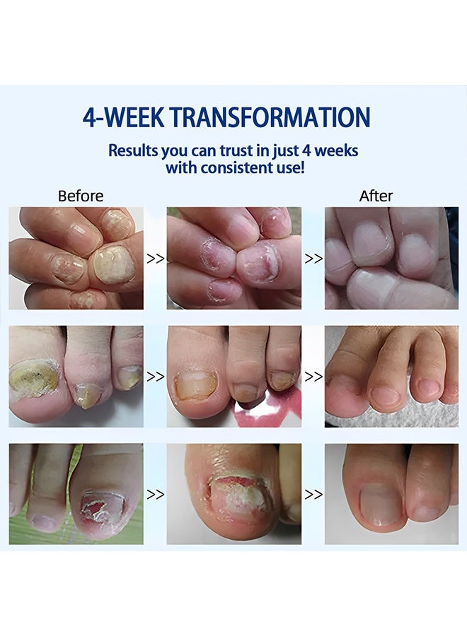 Sefudun Plant Drops， Nail Care Oregano Tea Tree Plant Drops for Nail Fungus Treatment Serum for Toenails and Fingernails Oregano Oil Fungal Nail Renewal Anti Fungus Nail Repair Gel 10ml - Image 4