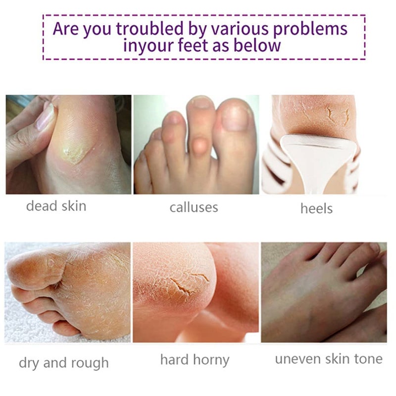 Mcukv Foot Peel Masks for Dry Cracked Feet 5 Pack,Exfoliating Foot Mask, Natural Exfoliator for Dead Skin, Callus, Repair Rough Heels for Men Women,Make your Foot Baby Soft in 7 Days, AlIVER - Image 2