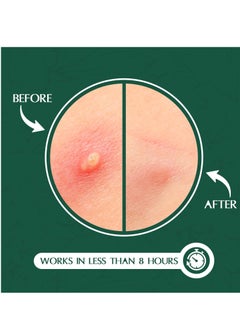 Aroura Aroura Premium Pimple Acne Patches Invisible (120 Pack) - For Day and Night - Hydrocolloid Acne Dots for Clear Skin - Advanced Zit Patches and Acne Stickers  - Image 5