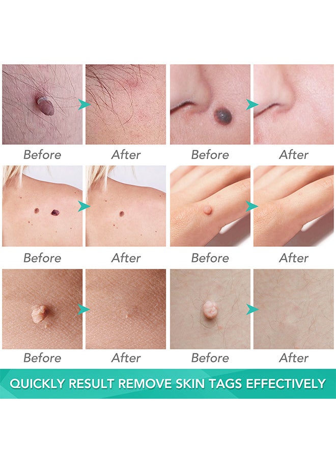 Sefudun - 2 In 1 Skin Tag Removal Tool Kit Painless Easy-Using Device For Small To Large Sized Skin Tag On Face Neck And Body， Double Head Wart Removal Tool Skin Tag Removal Green - Image 1