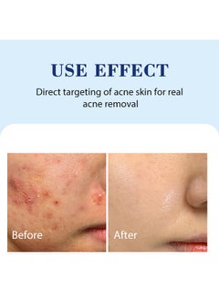 Salicylic Acid Acne Cream，Deep Moisturizing Oil Control Smoothing Acne Cream with 2% Salicylic Acid Soothing Cream for Acne Skin Hydrating Oil Control Pore Tightening Acne Cream 20g - pzsku/ZCF708512D8A5DD7624FAZ/45/1741164795/0701d589-2523-4f07-95ba-c4ec8e5b2fa1