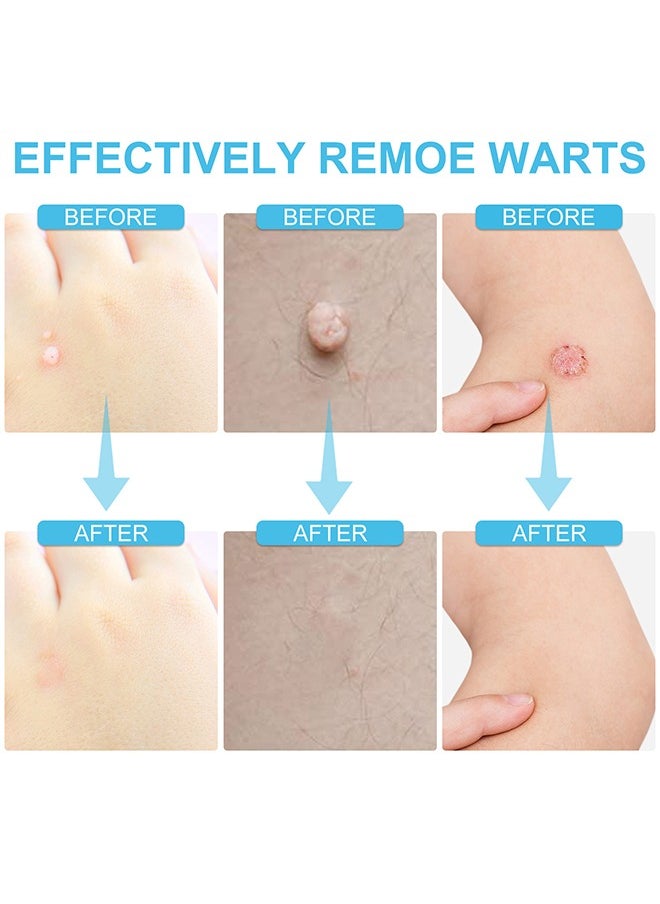 Skin Tag Remover Mole Remover Effectively Removes Skin Tag And Mole Quick Results And Effective All Natural Extract Suitable For All Skin Types Easy Use At Home 30ML