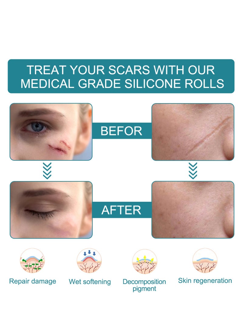 Elaimei Scar Roll Sticker Self-Adhesive Scar Removal Sticker 4CM*1.5M - Image 3