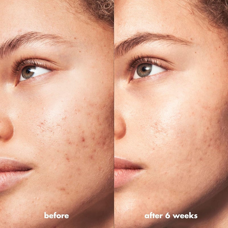 elf e.l.f. SKIN Blemish Breakthrough Calming Water Cream, Lightweight Blemish-Fighting Face Moisturiser, Prevents New Blemishes & Calms Skin - Image 4