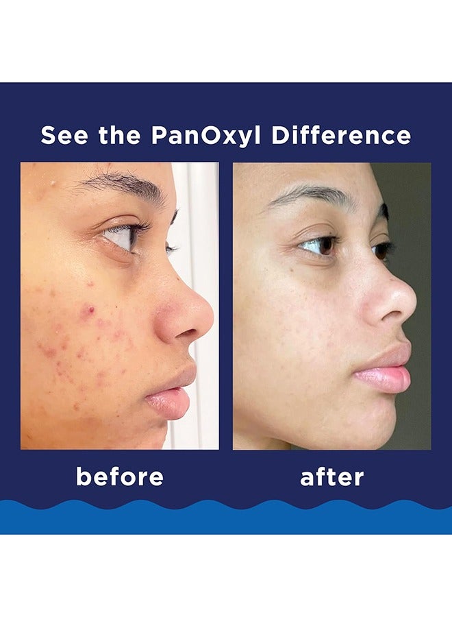 PanOxyl Acne Foaming Wash, Peroxide 10% Maximum Strength 5.5 Oz  + Adapalene Gel Usp, 0.1%, Acne Treatment 15grams - Image 5
