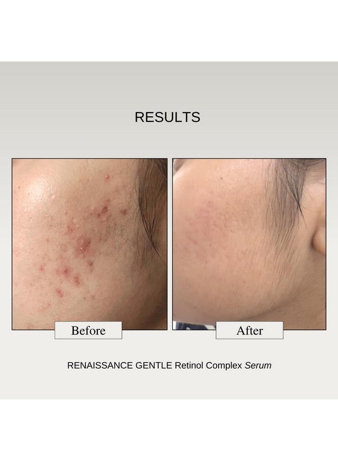The Formularx 0.1% Retinol + 0.5% Granactive Retinol Gentle Complex Serum With Niacinamide & Bakuchiol | For Acne, Acne Marks, Dark Spots, Wrinkles, & Pores | Anti Aging & Brightening Face Serum | 30G - Image 4