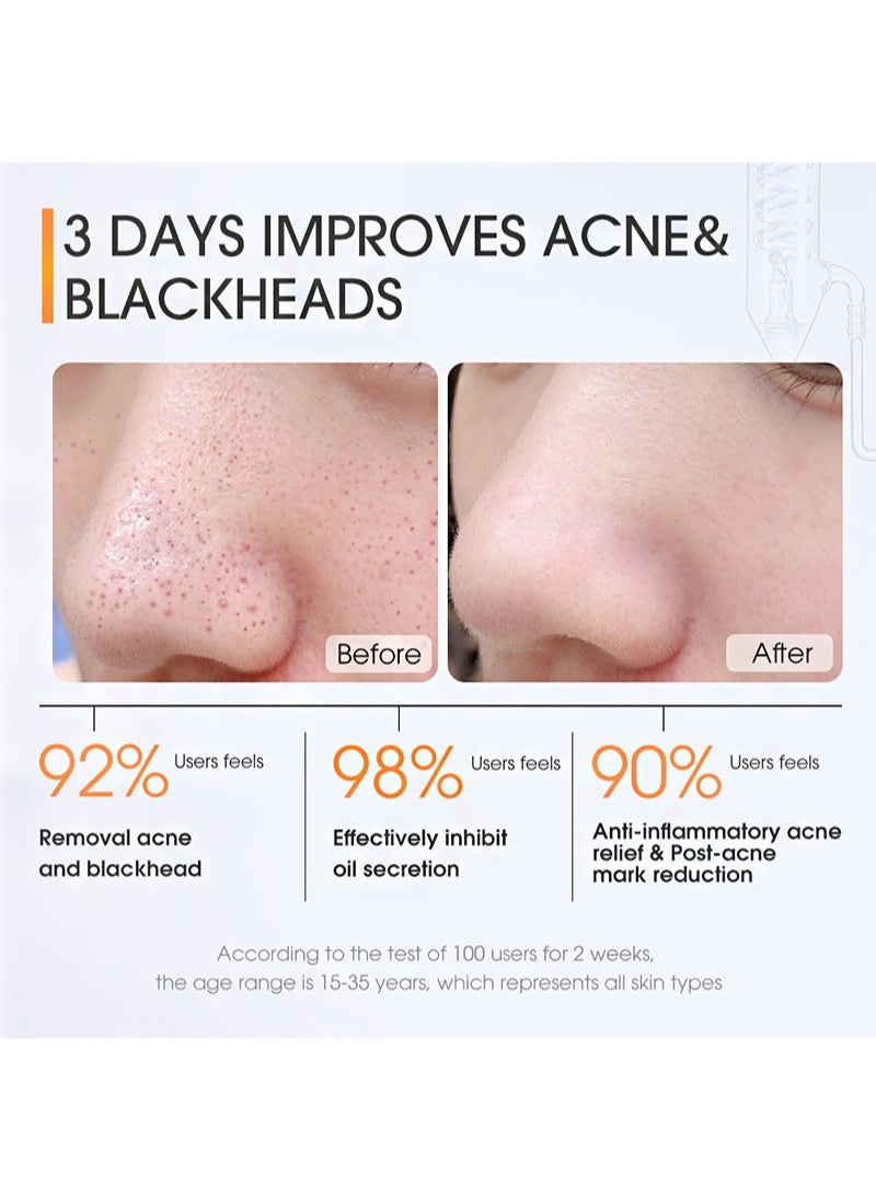 Salicylic Acid Refreshing Acne Skin Pads，2% Salicylic Acid Acne Pads, Acne Pads, Exfoliating Cleansing Wipes, Can Remove Dark Spots, Blackheads, Acne (30 Pieces)