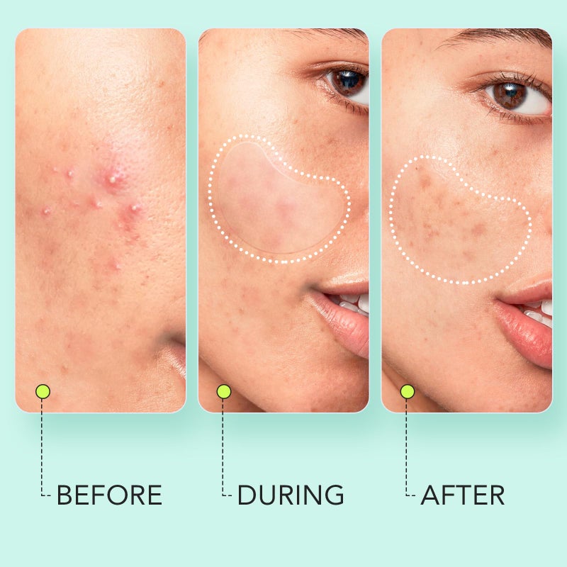 LitBear Large Pimple Patches (7 Sizes 306 Patches), Big Acne Patches, XL Hydrocolloid Bandages for Full Face, Forehead, Chin, Nose, Body, Back, Neck & Chest, Oval, Moon, Square hydrocolloid Patch - Image 5