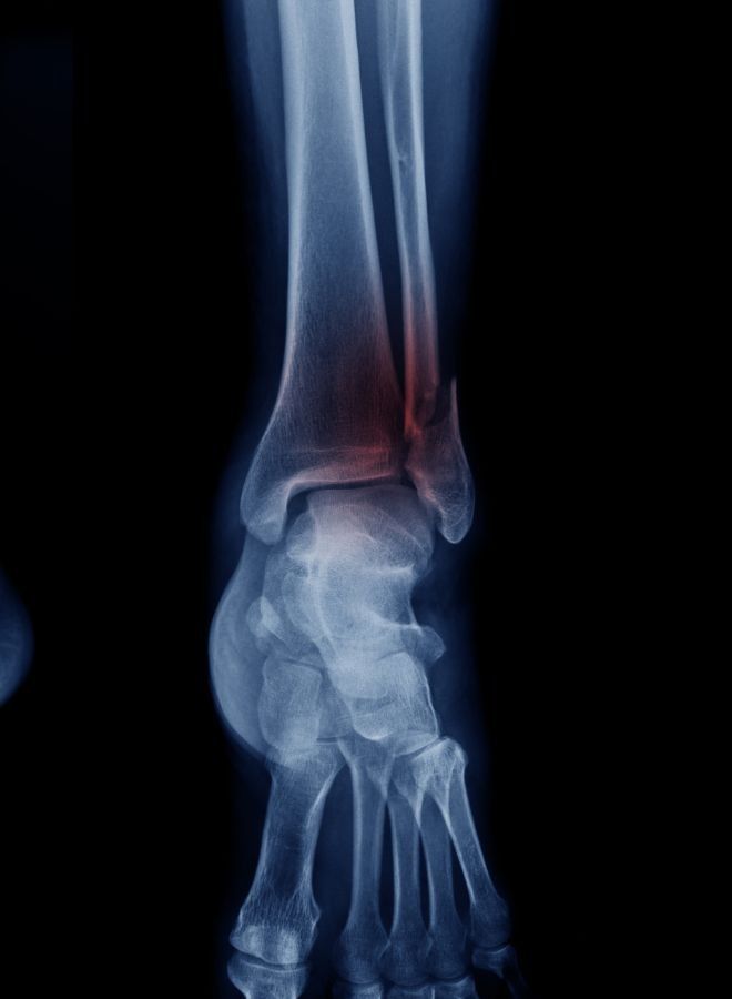 موف حذاء Rocking طويل لتعافي الإصابات وتحسين الحركة – MV086 موف - Image 5