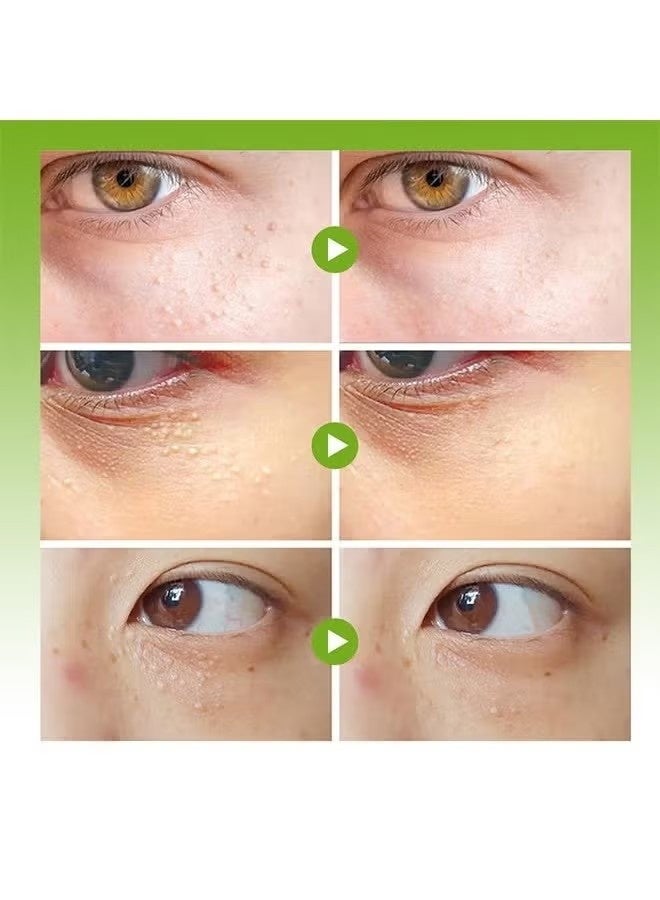 Sumifun Milia Removal Essential, Milia Spot Treatment Helps Dissolve And Reduce Milia, Whitehead And Sebaceous Hyperplasia 20G - Image 5