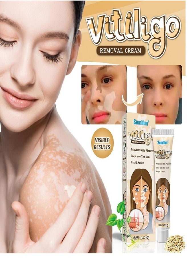 Vitiligo Skin Care Cream, Reduce White Spots, Vitiligo Cream, Improve Skin Pigmentation (1pc) - pzsku/ZD0D2C7CD3AC7A66229B5Z/45/_/1723021511/4e7ac499-5c15-4e98-88cf-0ec8af5b95c9