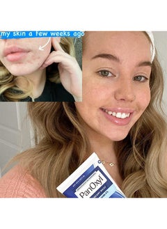 abreva Panoxyl 4% Benzoyl Peroxide Creamy Acne Wash 6 Ounce (Value Pack Of 5)  - Image 3