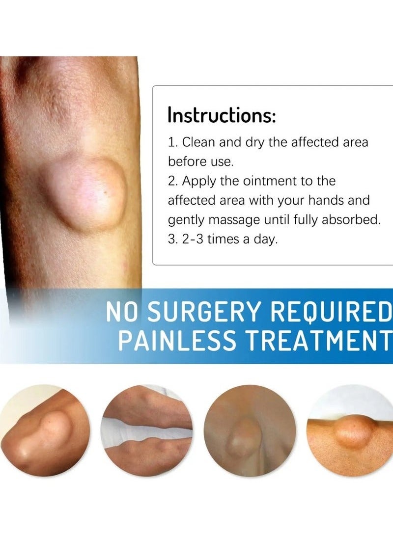 SOUTH MOON Lipoma Removal Cream 20g, Lipoma Removal Cream Ointment, Lipoma Elimination Cream, Get Rid of Your Fatty Lipoma Lumps - Image 3