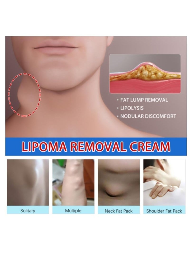 SOUTH MOON Lipoma Removal Cream 20g, Lipoma Removal Cream Ointment, Lipoma Elimination Cream, Get Rid of Your Fatty Lipoma Lumps - Image 5