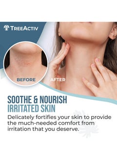 TreeActiv Seborrheic Dermatitis Cream 8Oz Psoriasis Cream For Face And Body Hydrating Seborrheic Dermatitis Treatment Eczema Psoriasis Cream For Scalp Dry Skin Lotion And Body Cream 500+ Uses  - Image 2