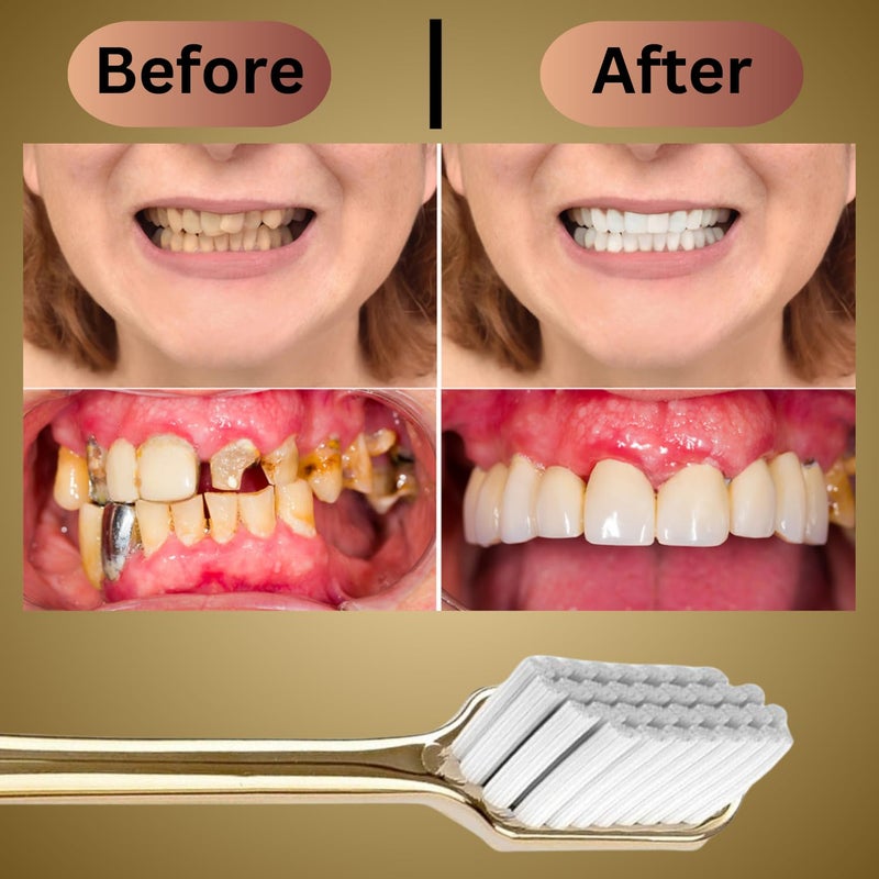 KICKZU V-Shaped Orthodontic Toothbrush for Braces, Soft Bristles | No Interdental Brushes Included | Extra soft & gentle bristles | Reaches all the critical areas including gum line - Image 4