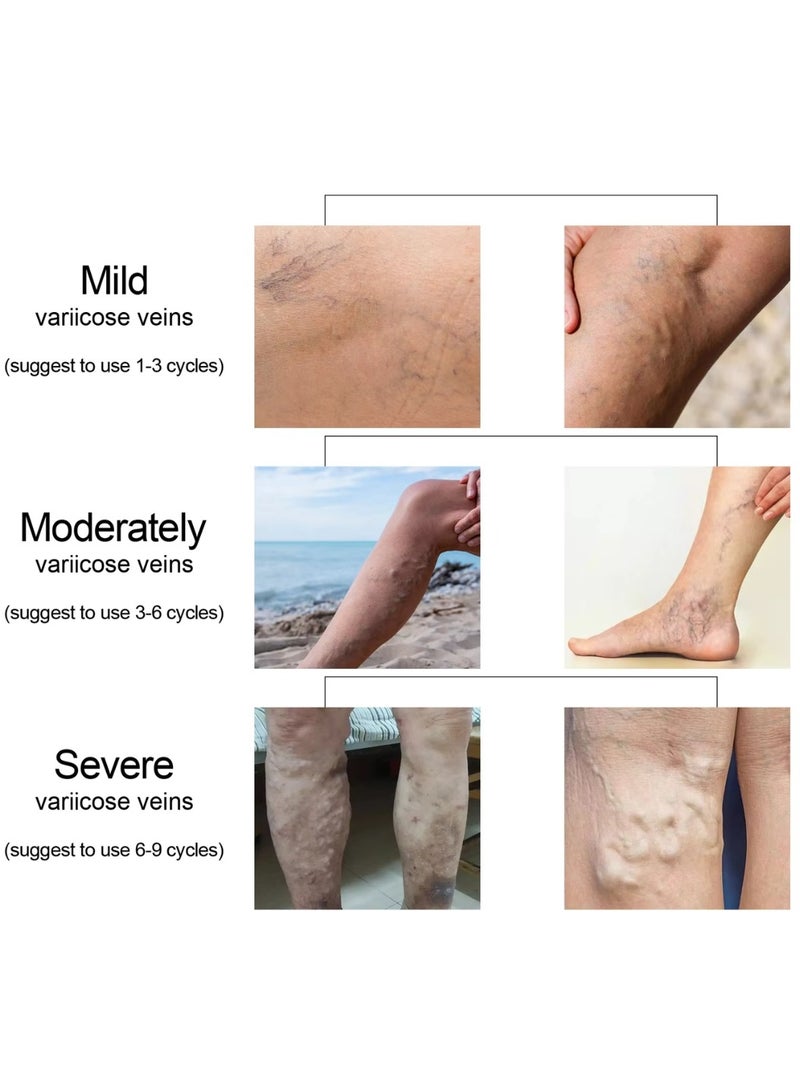 Jaysuing Varicose Cream Improve Spider Veins Varicose Veins Cream Relieve Swelling Varicose Vein Removal Ointment Eliminate Appearance of Varicose Veins Vein Inflammation Treatment 20g  - Image 3