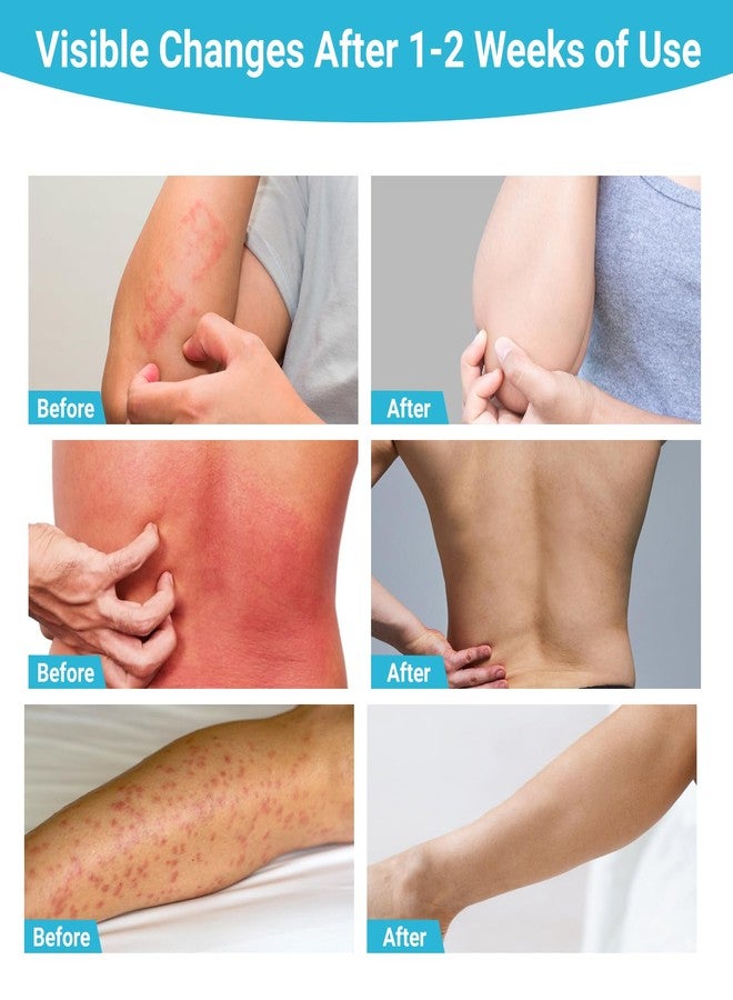 ishancare كريم إيشان كير المضاد للفطريات، كريم طبيعي بالكامل مضاد للفطريات للبشرة لعلاج قدم الرياضي، وحكة الفخذ، والقوباء الحلقية، والنخالية المبرقشة، والعدوى الفطرية، 3.53 أونصة - Image 5