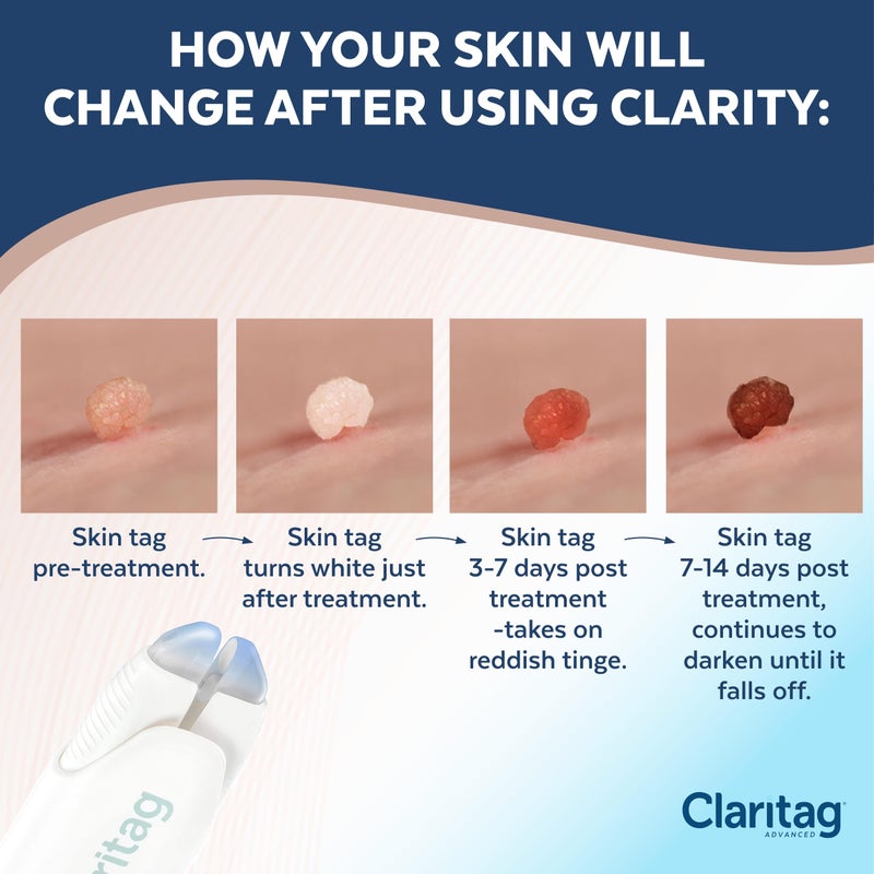 Claritag Advanced Skin Tag Remover - FDA-Cleared Device - Only for Skin Tag Removal - Works in 7-14 Days - Up to 10 Treatment Cycles - Cryogenic Freeze-Off Kit - Image 4