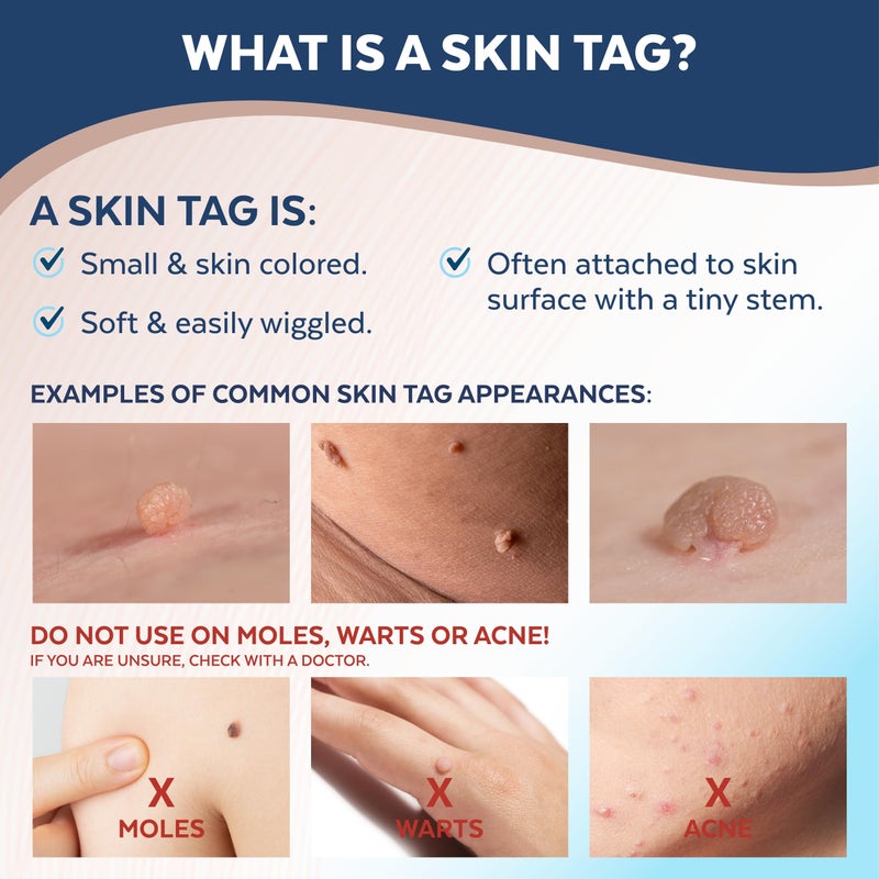 Claritag Advanced Skin Tag Remover - FDA-Cleared Device - Only for Skin Tag Removal - Works in 7-14 Days - Up to 10 Treatment Cycles - Cryogenic Freeze-Off Kit - Image 3