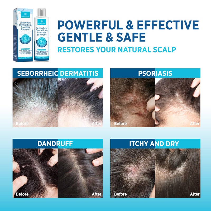 Roycederm Seborrheic Dermatitis & Psoriasis Cream, Shampoo and Conditioner Set - Scalp Therapy System for Folliculitis, Psoriasis, Dandruff, Dry Scalp - Scalp Treatment to Relieve Itching, Flaking, Irritation - Image 3