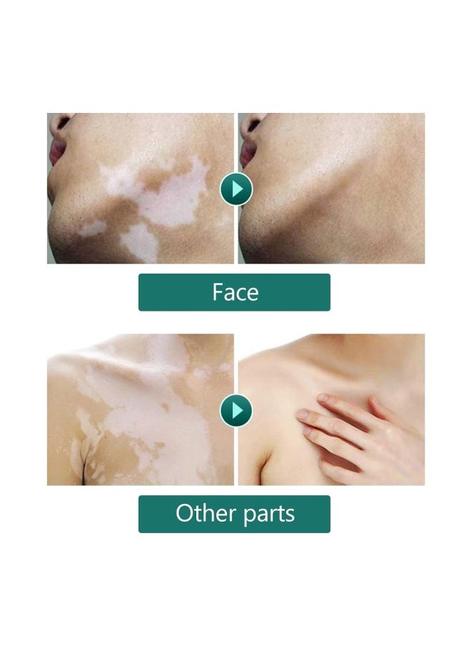 klarako - 20ml Vitiligo Covering Liquid, White spot concealer, Waterproof Makeup Vitiligo Concealer Cosmetics for Face Body, skin tone concealer - Image 1