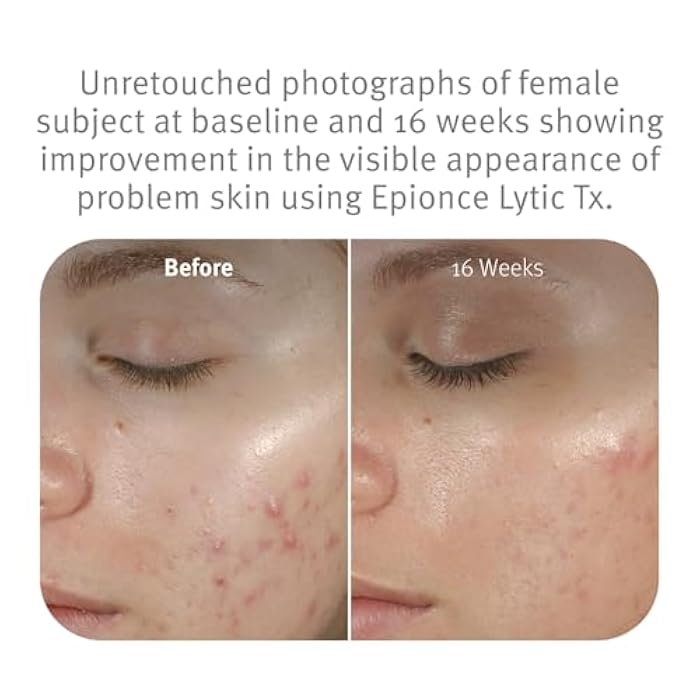 Epionce Lytic Tx - Product for Combination to Oily & Problem Skin with Salicylic Acid, Hyaluronic Acid & Azelaic Acid, Dermatologist Skincare - Image 4