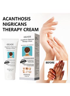 Acanthosis Nigricans Therapy Cream- with Lactic Acid ,Dermatologist Tested Retinol Cream , Hyperpigmentation Removal Cream , For Dark Body Parts like Neck Ankles Knuckles Armpits 50g